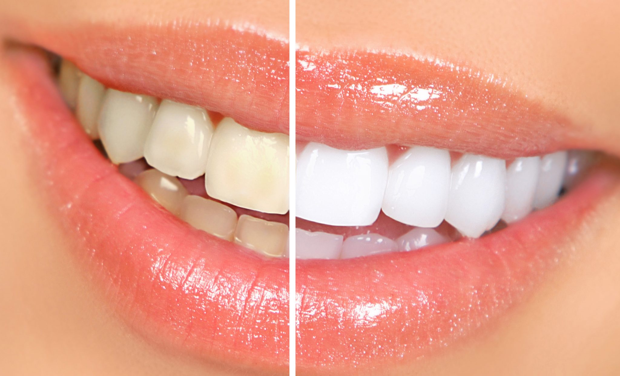 Tẩy trắng răng có an toàn ?