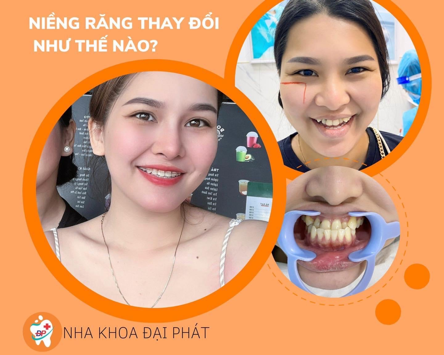 Góc giải đáp: Niềng răng khểnh có phải nhổ răng không?